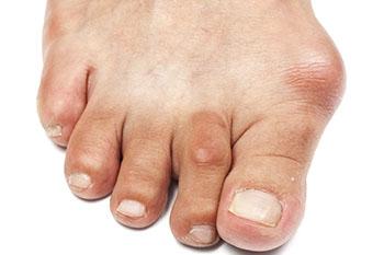 Bunions treatment in the Wayne, NJ 07470 and Caldwell, NJ 07006 areas